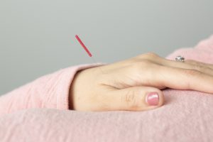 How to get natural Headache relief - Acupuncture Clinic Sydney