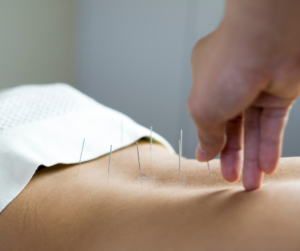 Acupuncture_Back_Pain
