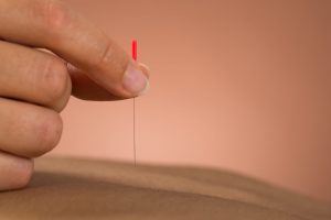 Postnatal Acupuncture